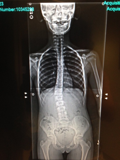 Scoliosis - After