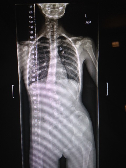 Scoliosis - Before